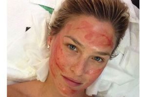 bar-refaeli-after-vampire-facial
